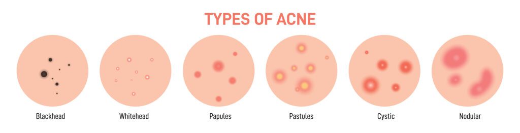 image of different types of acne